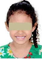 Initial orthodontic documentation: a) extraoral smiling photograph; b) frontal extraoral photograph; c) lateral extraoral photograph; d) lateral cephalometric teleradiograph; e) intraoral photograph of the right side; f) frontal intraoral photograph; g) intraoral photograph of the left side; h) panoramic radiograph