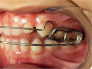 Appliance Photographs – June 3, 2022: a) right-side intraoral photograph; b) frontal intraoral photograph; c) left-side intraoral photograph; d) photograph of the appliance placed on the study model