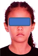 Orthodontic records – December 12, 2022: a) frontal extraoral photograph; b) smiling extraoral photograph; c) right lateral extraoral photograph; d) right intraoral photograph; e) frontal intraoral photograph; f) left intraoral photograph; g) panoramic radiograph; h) lateral cephalometric radiograph