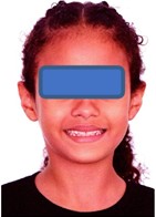 Orthodontic records – December 12, 2022: a) frontal extraoral photograph; b) smiling extraoral photograph; c) right lateral extraoral photograph; d) right intraoral photograph; e) frontal intraoral photograph; f) left intraoral photograph; g) panoramic radiograph; h) lateral cephalometric radiograph