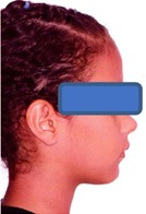 Orthodontic records – December 12, 2022: a) frontal extraoral photograph; b) smiling extraoral photograph; c) right lateral extraoral photograph; d) right intraoral photograph; e) frontal intraoral photograph; f) left intraoral photograph; g) panoramic radiograph; h) lateral cephalometric radiograph