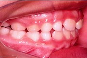 Orthodontic records – December 12, 2022: a) frontal extraoral photograph; b) smiling extraoral photograph; c) right lateral extraoral photograph; d) right intraoral photograph; e) frontal intraoral photograph; f) left intraoral photograph; g) panoramic radiograph; h) lateral cephalometric radiograph