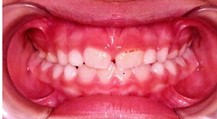 Orthodontic records – December 12, 2022: a) frontal extraoral photograph; b) smiling extraoral photograph; c) right lateral extraoral photograph; d) right intraoral photograph; e) frontal intraoral photograph; f) left intraoral photograph; g) panoramic radiograph; h) lateral cephalometric radiograph