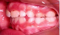 Orthodontic records – December 12, 2022: a) frontal extraoral photograph; b) smiling extraoral photograph; c) right lateral extraoral photograph; d) right intraoral photograph; e) frontal intraoral photograph; f) left intraoral photograph; g) panoramic radiograph; h) lateral cephalometric radiograph