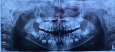 Orthodontic records – December 12, 2022: a) frontal extraoral photograph; b) smiling extraoral photograph; c) right lateral extraoral photograph; d) right intraoral photograph; e) frontal intraoral photograph; f) left intraoral photograph; g) panoramic radiograph; h) lateral cephalometric radiograph