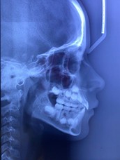 Orthodontic records – December 12, 2022: a) frontal extraoral photograph; b) smiling extraoral photograph; c) right lateral extraoral photograph; d) right intraoral photograph; e) frontal intraoral photograph; f) left intraoral photograph; g) panoramic radiograph; h) lateral cephalometric radiograph