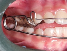 Photographs taken on February 10, 2025, intraoral views with the appliance in place and without the appliance: a) photograph with the appliance in place, right side view; b) photograph with the appliance in place, left side view; c) frontal intraoral photograph with the appliance in place; d) intraoral photograph of the appliance with an occlusal view showing the central expander; e) intraoral photograph without the appliance, right side view; f) frontal intraoral photograph without the appliance; g) intraoral photograph without the appliance, left side view