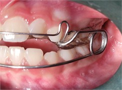 Photographs taken on February 10, 2025, intraoral views with the appliance in place and without the appliance: a) photograph with the appliance in place, right side view; b) photograph with the appliance in place, left side view; c) frontal intraoral photograph with the appliance in place; d) intraoral photograph of the appliance with an occlusal view showing the central expander; e) intraoral photograph without the appliance, right side view; f) frontal intraoral photograph without the appliance; g) intraoral photograph without the appliance, left side view