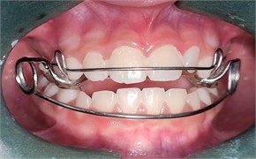 Photographs taken on February 10, 2025, intraoral views with the appliance in place and without the appliance: a) photograph with the appliance in place, right side view; b) photograph with the appliance in place, left side view; c) frontal intraoral photograph with the appliance in place; d) intraoral photograph of the appliance with an occlusal view showing the central expander; e) intraoral photograph without the appliance, right side view; f) frontal intraoral photograph without the appliance; g) intraoral photograph without the appliance, left side view