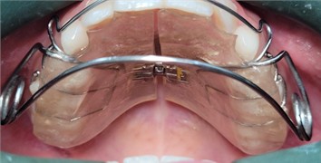 Photographs taken on February 10, 2025, intraoral views with the appliance in place and without the appliance: a) photograph with the appliance in place, right side view; b) photograph with the appliance in place, left side view; c) frontal intraoral photograph with the appliance in place; d) intraoral photograph of the appliance with an occlusal view showing the central expander; e) intraoral photograph without the appliance, right side view; f) frontal intraoral photograph without the appliance; g) intraoral photograph without the appliance, left side view
