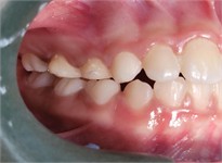 Photographs taken on February 10, 2025, intraoral views with the appliance in place and without the appliance: a) photograph with the appliance in place, right side view; b) photograph with the appliance in place, left side view; c) frontal intraoral photograph with the appliance in place; d) intraoral photograph of the appliance with an occlusal view showing the central expander; e) intraoral photograph without the appliance, right side view; f) frontal intraoral photograph without the appliance; g) intraoral photograph without the appliance, left side view