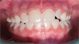 Photographs taken on February 10, 2025, intraoral views with the appliance in place and without the appliance: a) photograph with the appliance in place, right side view; b) photograph with the appliance in place, left side view; c) frontal intraoral photograph with the appliance in place; d) intraoral photograph of the appliance with an occlusal view showing the central expander; e) intraoral photograph without the appliance, right side view; f) frontal intraoral photograph without the appliance; g) intraoral photograph without the appliance, left side view