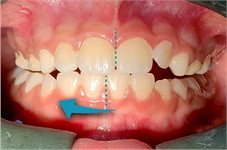 Functional intraoral photographs with mandibular movements: a) intraoral photograph with protrusive movement; b) intraoral photograph with right lateral mandibular movement; c) intraoral photograph with left lateral mandibular movement