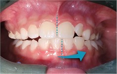 Functional intraoral photographs with mandibular movements: a) intraoral photograph with protrusive movement; b) intraoral photograph with right lateral mandibular movement; c) intraoral photograph with left lateral mandibular movement