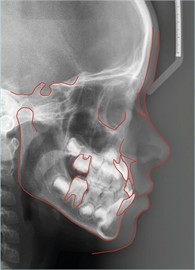 Cephalometric analyses: a) initial cephalometric analysis of the patient, performed in August 2021 traced in the color red; b) cephalometric analysis performed in December 2022 cephalometric analysis was performed in December 2022 and traced in yellow. Superimposition of the two cephalometric analyses