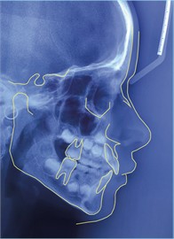 Cephalometric analyses: a) initial cephalometric analysis of the patient, performed in August 2021 traced in the color red; b) cephalometric analysis performed in December 2022 cephalometric analysis was performed in December 2022 and traced in yellow. Superimposition of the two cephalometric analyses