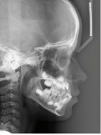 Initial orthodontic documentation: a) extraoral smiling photograph; b) frontal extraoral photograph; c) lateral extraoral photograph; d) lateral cephalometric teleradiograph; e) intraoral photograph of the right side; f) frontal intraoral photograph; g) intraoral photograph of the left side; h) panoramic radiograph