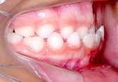 Initial orthodontic documentation: a) extraoral smiling photograph; b) frontal extraoral photograph; c) lateral extraoral photograph; d) lateral cephalometric teleradiograph; e) intraoral photograph of the right side; f) frontal intraoral photograph; g) intraoral photograph of the left side; h) panoramic radiograph