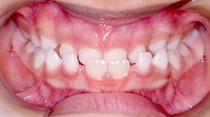 Initial orthodontic documentation: a) extraoral smiling photograph; b) frontal extraoral photograph; c) lateral extraoral photograph; d) lateral cephalometric teleradiograph; e) intraoral photograph of the right side; f) frontal intraoral photograph; g) intraoral photograph of the left side; h) panoramic radiograph