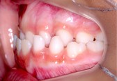 Initial orthodontic documentation: a) extraoral smiling photograph; b) frontal extraoral photograph; c) lateral extraoral photograph; d) lateral cephalometric teleradiograph; e) intraoral photograph of the right side; f) frontal intraoral photograph; g) intraoral photograph of the left side; h) panoramic radiograph
