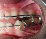 Appliance Photographs – June 3, 2022: a) right-side intraoral photograph; b) frontal intraoral photograph; c) left-side intraoral photograph; d) photograph of the appliance placed on the study model