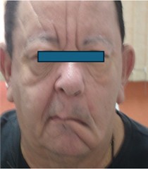 Approximately 45 days after treatment initiation
