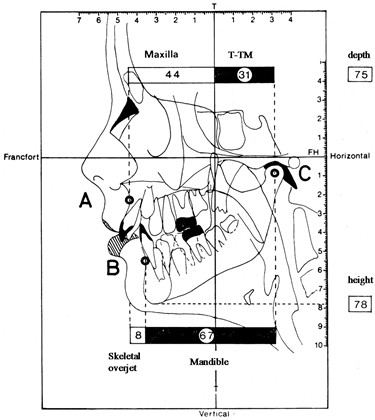 Three linear measurements as proposed by Bimler 1961. From: Lineare Messungen am Fernröntgenbild, Fortschr. Kieferortho,36, 1975, p. 36. (The linear measurement approach goes back to Wendell L. Wylie, (1913-1966) an American orthodontist who served as a President of American Board and the Chief Editor for The Angle Orthodontist Journal.) Here, the three measurements are supplemented by the „Skeletal Overjet” = point A to point B, the skeletal sagittal relation