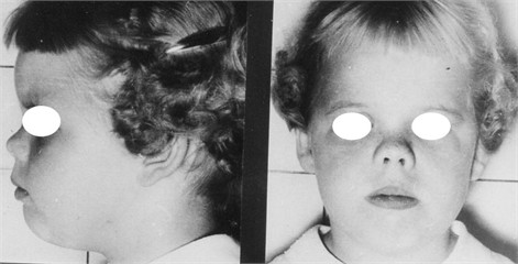 The Micro-rhinic Dysplasia. First published in Revista Española De Estomatologia,  Vol. 14, No. 4, 279-303, Barcelona 1966. English translation 2012 by A. B. Bimler,  in: Jaw Functional Orthopedics and Craniofacial Growth, 2024