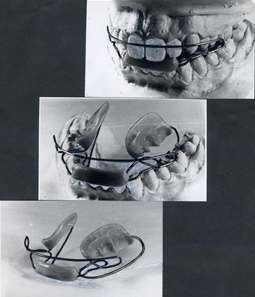 Historic Bimler A-type appliance. This photograph from the late 19540 shows a prototype  of the Bimler Appliance, still without the Coffin Spring and with the “cap” of the activator.  This would later be replace by the frontal splint and the lingual loop to guide the mandible  forward, at the same time securely avoiding an unwanted protrusion of the lower front