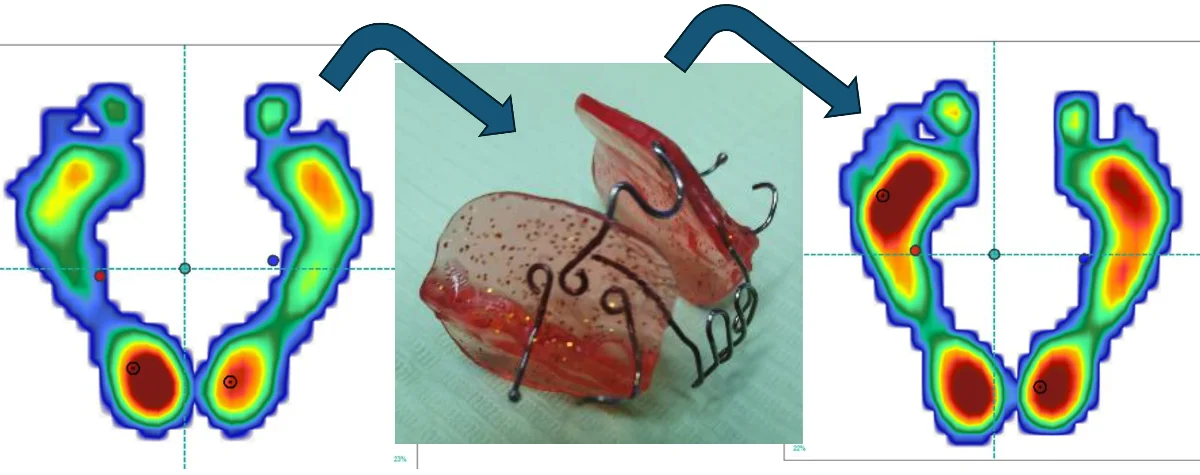 The effect of Cranial Postural Balance (CPB) appliance on re-establishing mandible and body posture in an adult patient. Case report