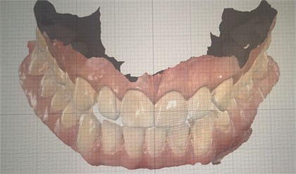 Beginning pictures: a) inclined view to show the negative overjet on posterior right, characterizing unilateral crossbite and generating midline deviation to the right; b) frontal view showing that in the manipulated position, avoiding dental interferences, the midline is almost centralized indicating that crossbite and deviation were positional due to narrowing of the palate requiring remodeling on both sides