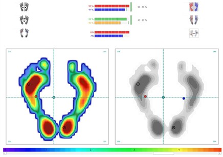 Baropodometer evaluation. On up panel the beginning register showing a body inclination to the crossbite side. On left the register after treatment showing a better posture balance