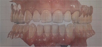 Beginning pictures: a) inclined view to show the negative overjet on posterior right, characterizing unilateral crossbite and generating midline deviation to the right; b) frontal view showing that in the manipulated position, avoiding dental interferences, the midline is almost centralized indicating that crossbite and deviation were positional due to narrowing of the palate requiring remodeling on both sides