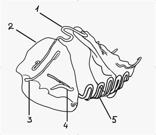 a) Design of the CPB: 1 – coffin spring, that can be constructed with the curvature for anterior  or posterior, depending on the necessity of each case, the position in the palate can also vary  depending on the transversal gain necessity; 2 – acrilic internal shield, 3 – posterior stabilizer,  4 – anterior stabilizer, 5 – curved wave bar to guide the position of the tongue, it can come  from superior down if the tongue is pressuring more superior and can come from inferior  up if the tongue is pressuring more inferior; b) real model of CPB