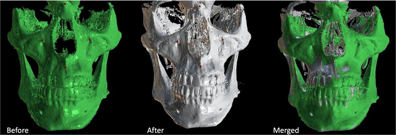 CBCT 3D reconstruction showing the effect of the therapeutic. Merged image  shows the high level of remodeling on right side