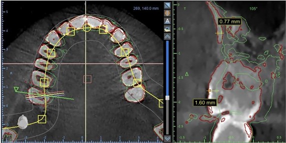 Teeth movement. The green line shows the original position of the teeth. On the right panel  it is possible to visualize the vestibular shift of bone and of the first molar, correcting the crossbite  showed on green line. Alveolar bone moved 0,77 mm and tooth crown 1,60 mm