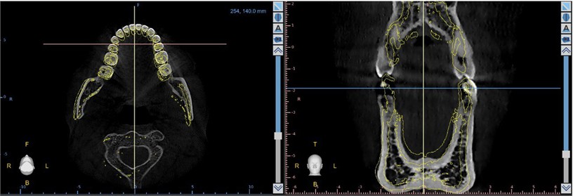 Inferior arch remodeling. Yellow lines show the initial shape  of the inferior arch and the original position of the teeth