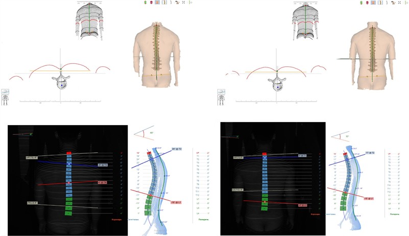 DIERS. Posterior evaluation of posture. On left up beginning and on right up after treatment with CPB and manual therapy showing improvement Sagittal evaluation of posture. On left down, beginning and on right down after treatment and manual therapy showing significative improvement