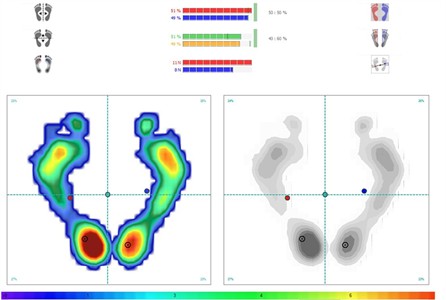 Baropodometer evaluation. On up panel the beginning register showing a body inclination to the crossbite side. On left the register after treatment showing a better posture balance