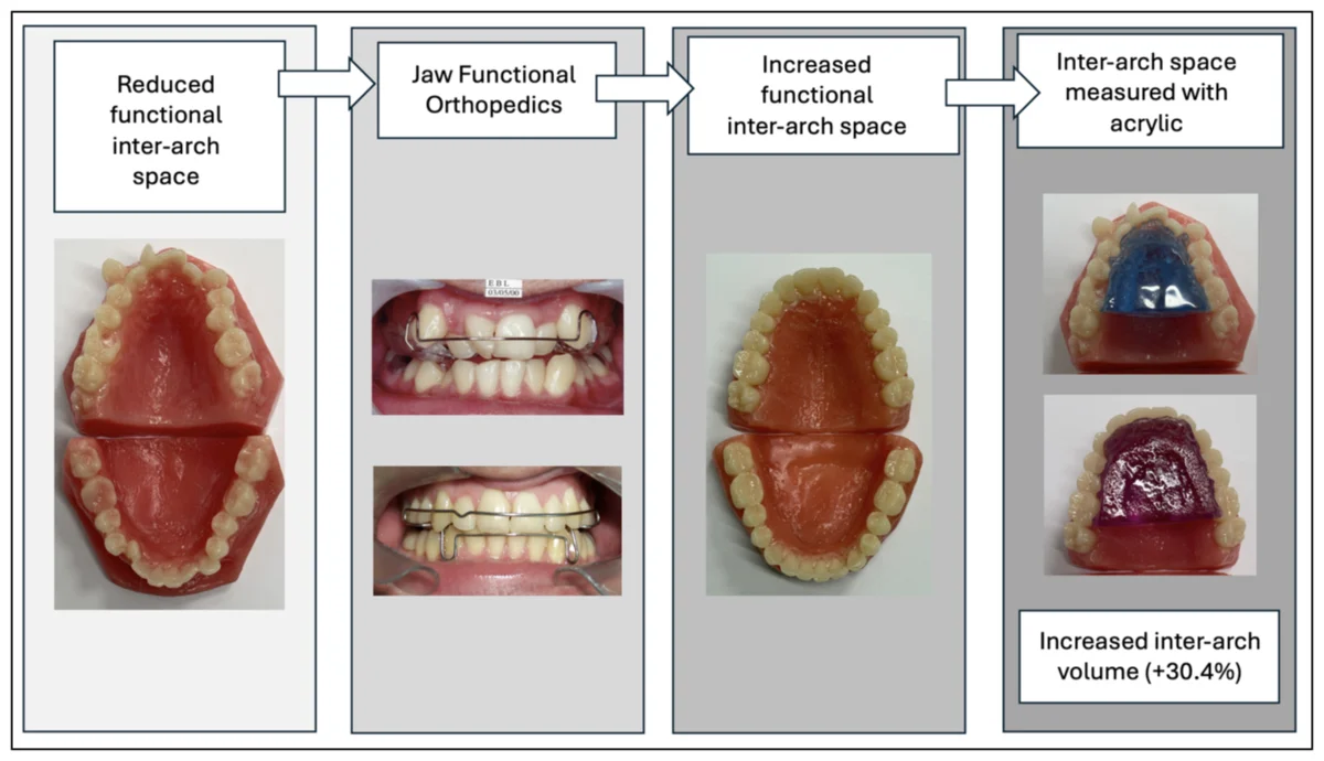 Volumetric changes in inter-arch space following malocclusion treatment: a pilot study