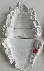 Working models of one of the patients who were involved in the study