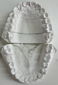 Working models of one of the patients who were involved in the study
