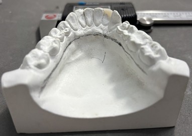 Measuring and limiting the lower part: 3 mm below the free marginal gingiva of the premolars