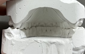 a) Articulated models; b) wax used to seal the resin exit; c) resin inserted into the previously isolated and hydrated model