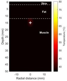Shows how the temperature and acoustic field change over time during HIFU therapy a), b) maps of the distribution of acoustic intensity, with a maximum acoustic intensity of 1000 W/cm2, clearly show  how concentrated the HIFU energy is in the focal region (depth ~15 mm); c) temperature field  distribution at t = 5 s; d) temperature field distribution at t = 20 s  (Notes: + marks the HIFU focal point, and dashed lines represent tissue boundaries)