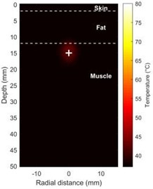 Shows how the temperature and acoustic field change over time during HIFU therapy a), b) maps of the distribution of acoustic intensity, with a maximum acoustic intensity of 1000 W/cm2, clearly show  how concentrated the HIFU energy is in the focal region (depth ~15 mm); c) temperature field  distribution at t = 5 s; d) temperature field distribution at t = 20 s  (Notes: + marks the HIFU focal point, and dashed lines represent tissue boundaries)