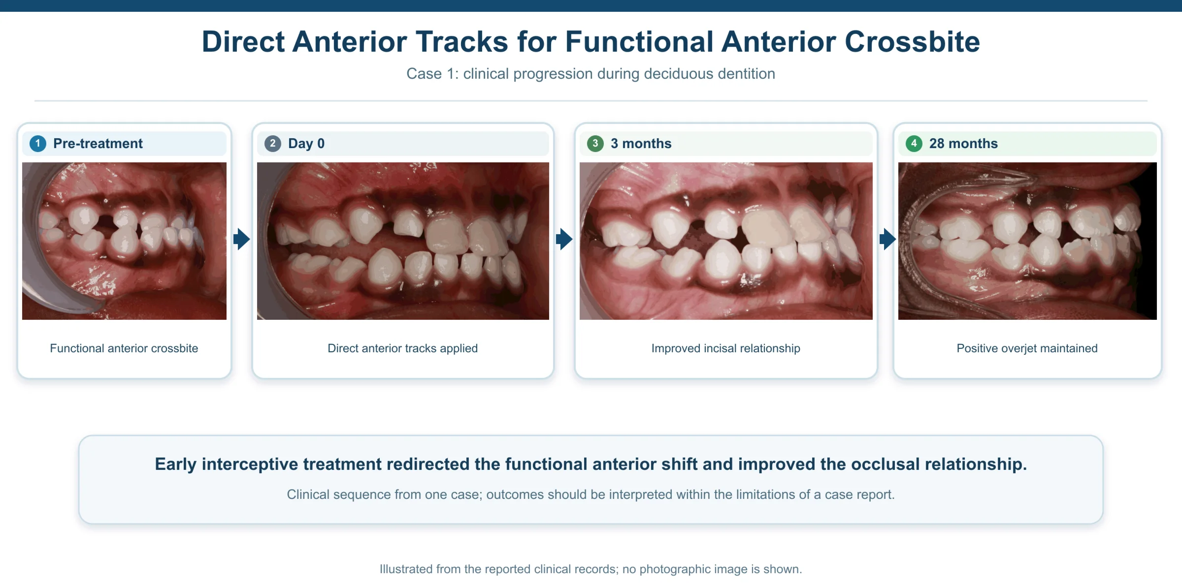 Management of anterior crossbite in siblings using direct anterior tracks in deciduous dentition: long-term follow-up of two case reports