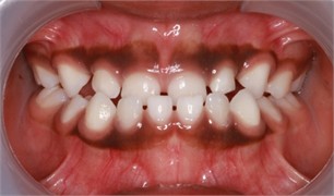 Sibling 1’s initial pictures: a) anterior view in maximum intercuspidation, b) manipulated position of the mandible, c) right-side view, d) left-side view, e) negative overjet
