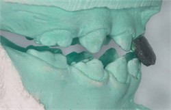 Laboratory procedure: a) the working models mounted on the articulator; b)-c) after building the direct tracks with modelling wax; d)-e) duplication and cast model; f) mock-up acetate trays made on duplicated model