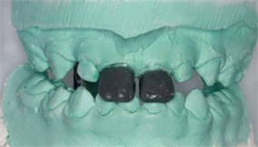 Laboratory procedure: a) the working models mounted on the articulator; b)-c) after building the direct tracks with modelling wax; d)-e) duplication and cast model; f) mock-up acetate trays made on duplicated model